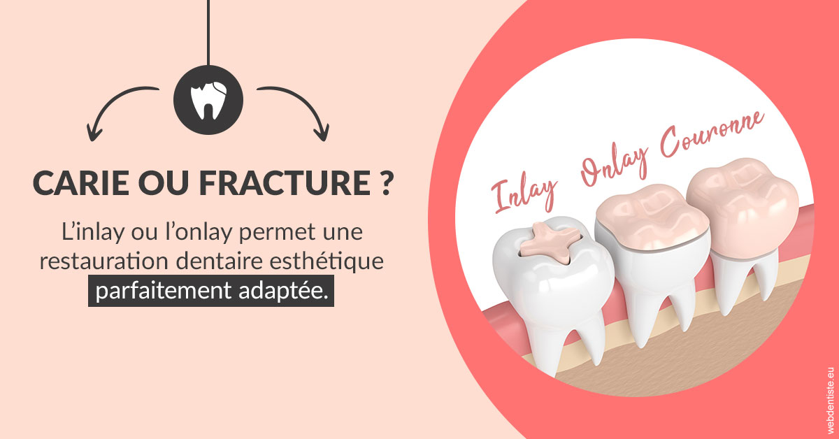 https://dr-tran-minh-thien.chirurgiens-dentistes.fr/T2 2023 - Carie ou fracture 2