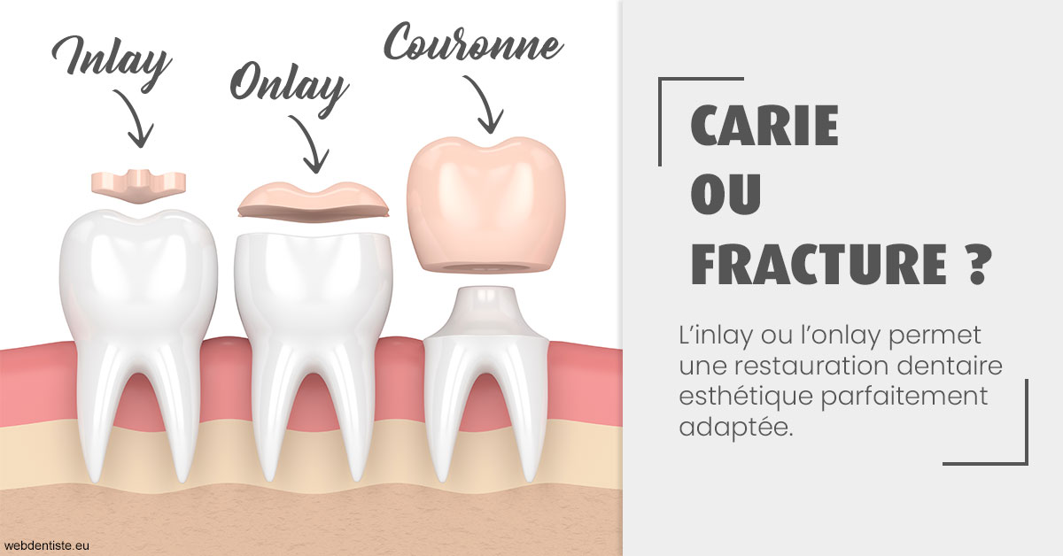 https://dr-tran-minh-thien.chirurgiens-dentistes.fr/T2 2023 - Carie ou fracture 1