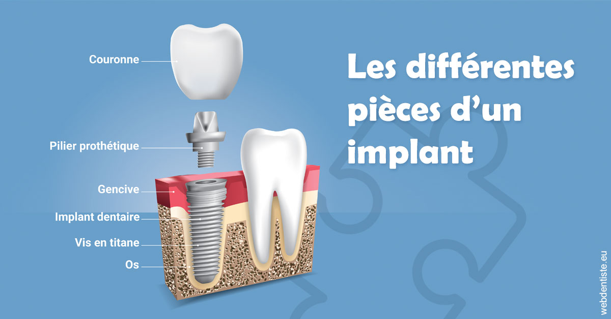 https://dr-tran-minh-thien.chirurgiens-dentistes.fr/Les différentes pièces d’un implant 1